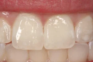 Close-up of smooth, even-toned upper front teeth after ICON white spot resin infiltration treatment.