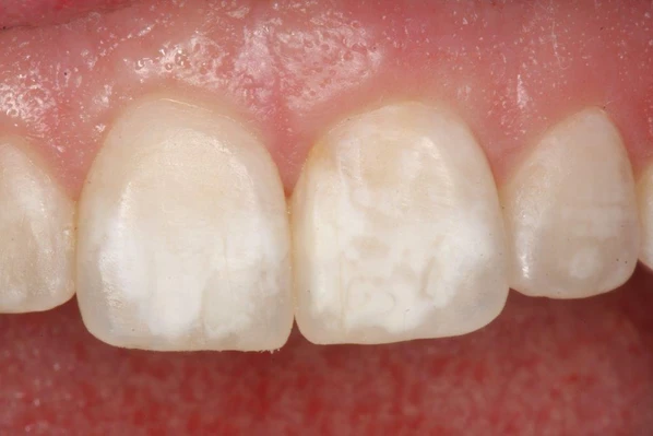 Close-up of upper front teeth showing white spot lesions on enamel before ICON treatment.