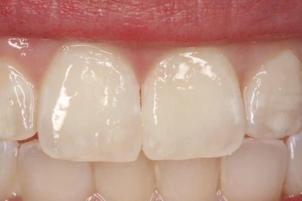Close-up of smooth, even-toned upper front teeth after ICON white spot resin infiltration treatment.