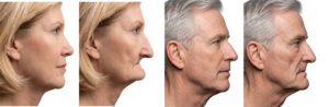 Four side-profile photos demonstrating facial collapse due to jawbone loss, showing a woman and a man before and after bone regression in the lower face.