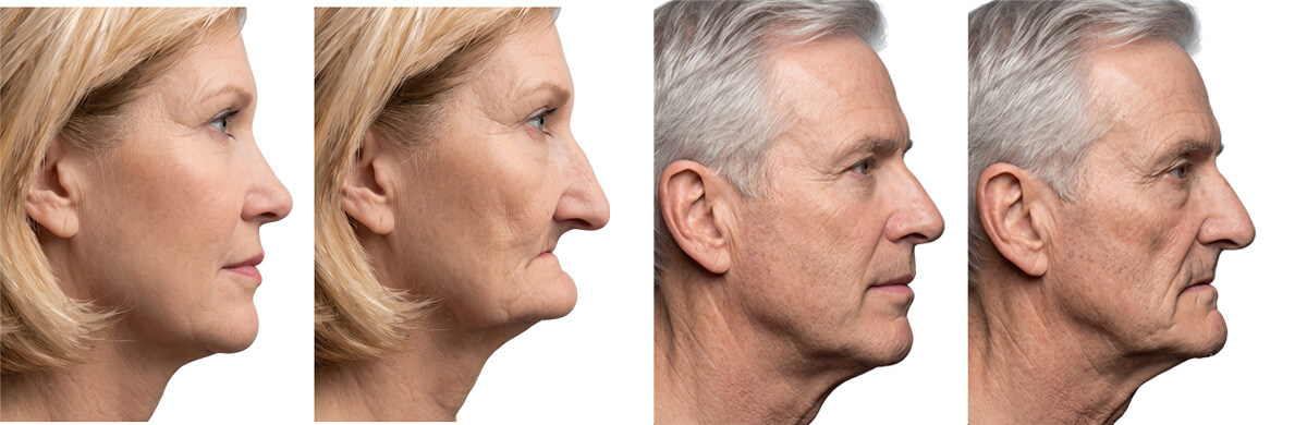 Four side-profile photos demonstrating facial collapse due to jawbone loss, showing a woman and a man before and after bone regression in the lower face.