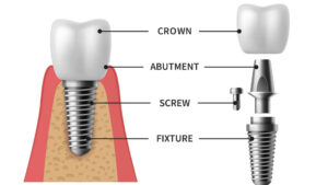 A diagram illustrating dental implant components, showing an assembled implant in the jaw on the left and a breakdown of its parts on the right, labeled from top to bottom as Crown, Abutment, Screw, and Fixture.